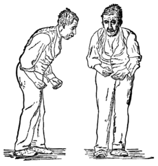 Parkinson's Disease - Stooped posture and paucity of movement